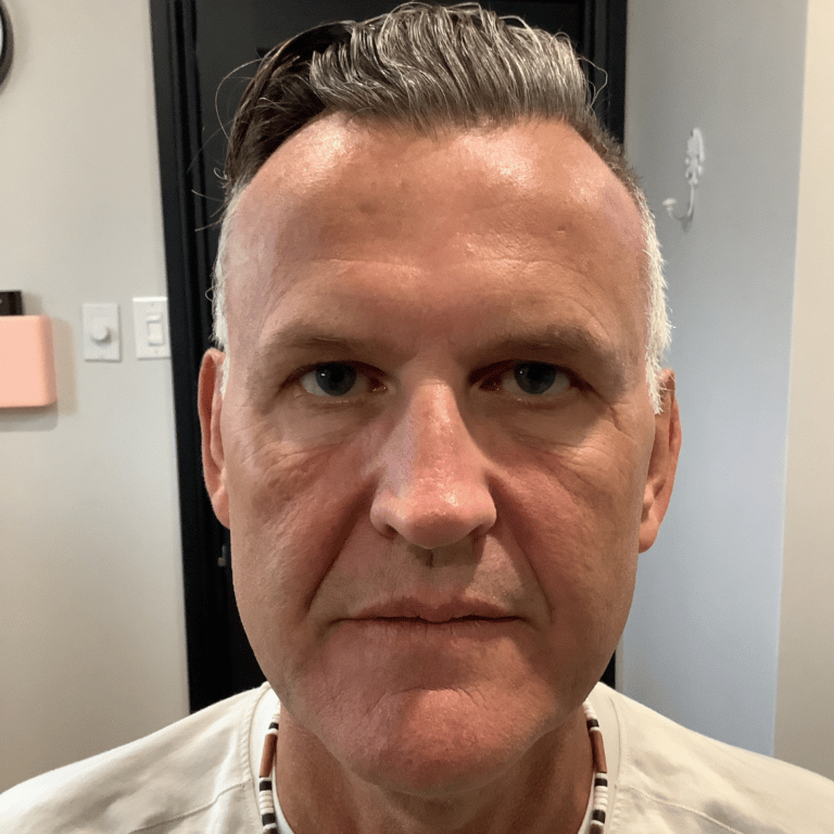 Before Image: Vampire Facial - front