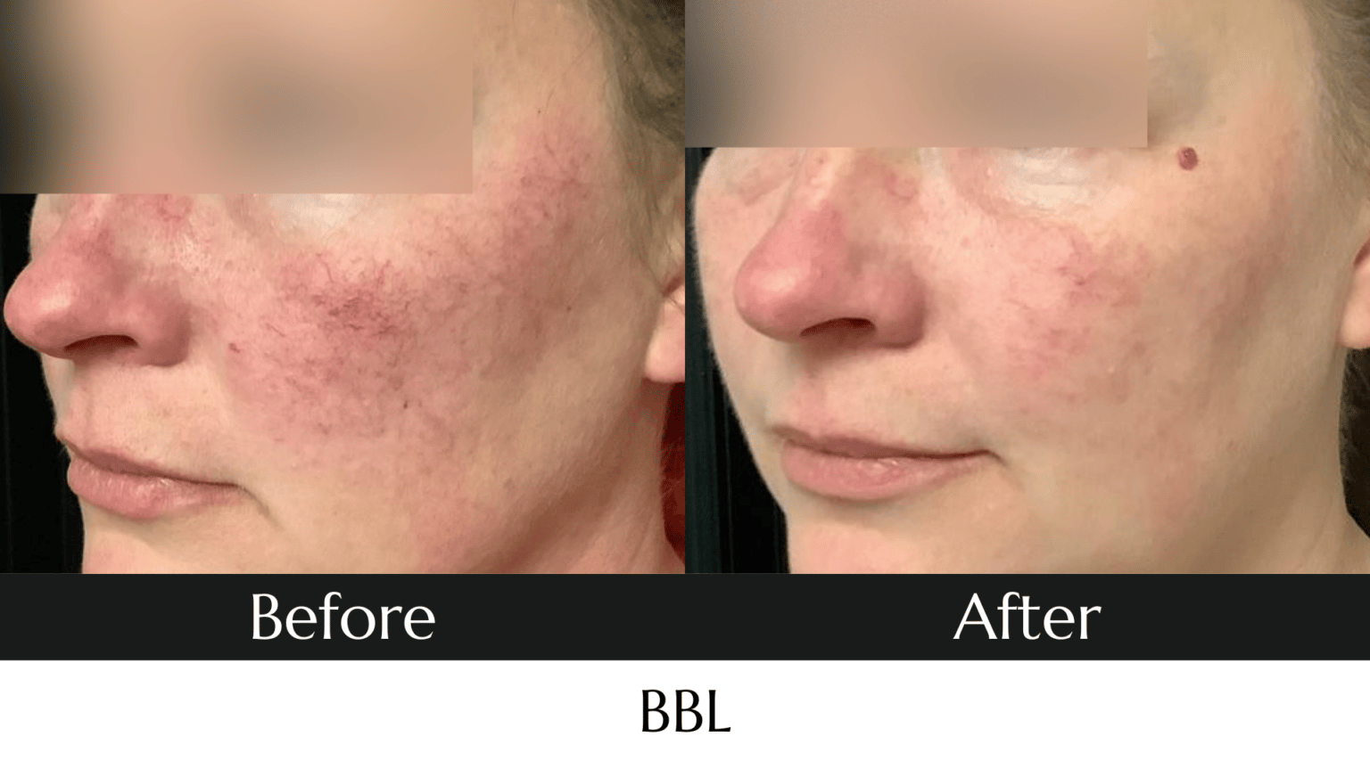 laser-pigment-removal