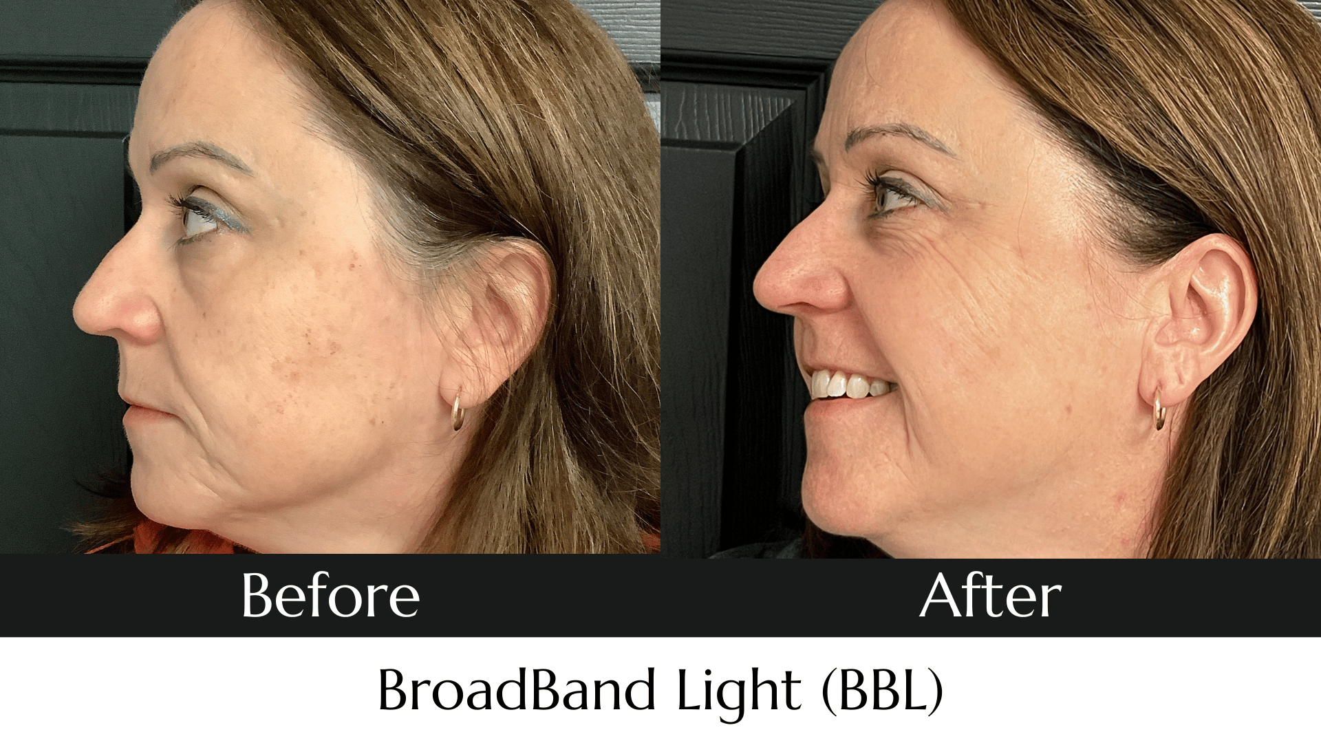 Laser Skin Tightening Near Me Get the Glow