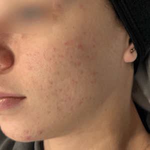 After Image: Salicylic Acid Peel – Acne
