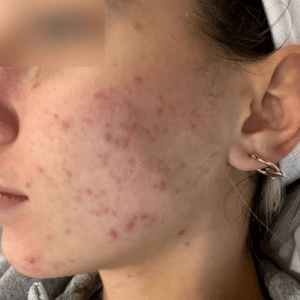 Before Image: Salicylic Acid Peel – Acne