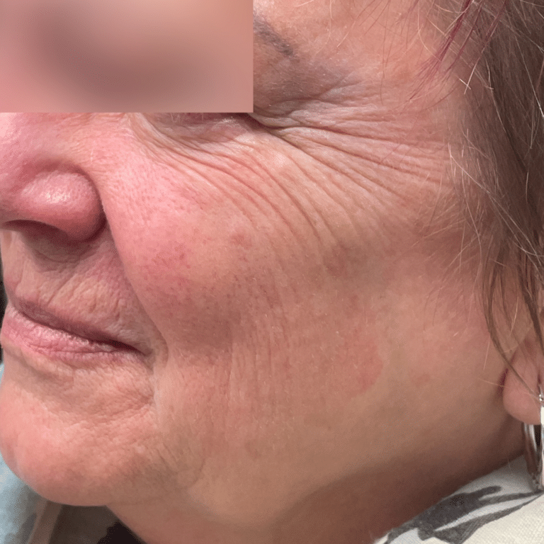 Before Image: BBL, Microneedling, Juvederm Filler - left-side