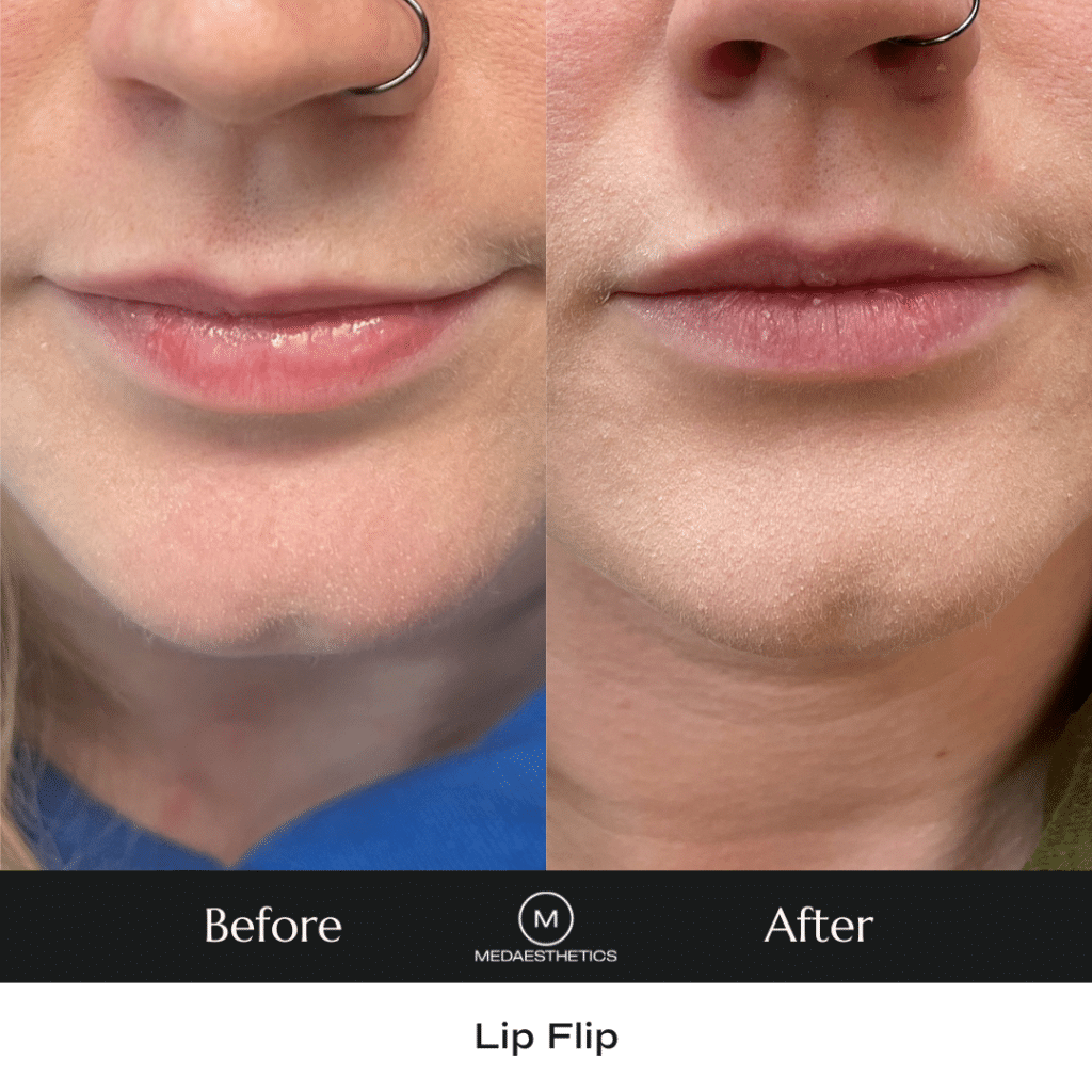 A photo of two lips side by side before and after a lip flip. 