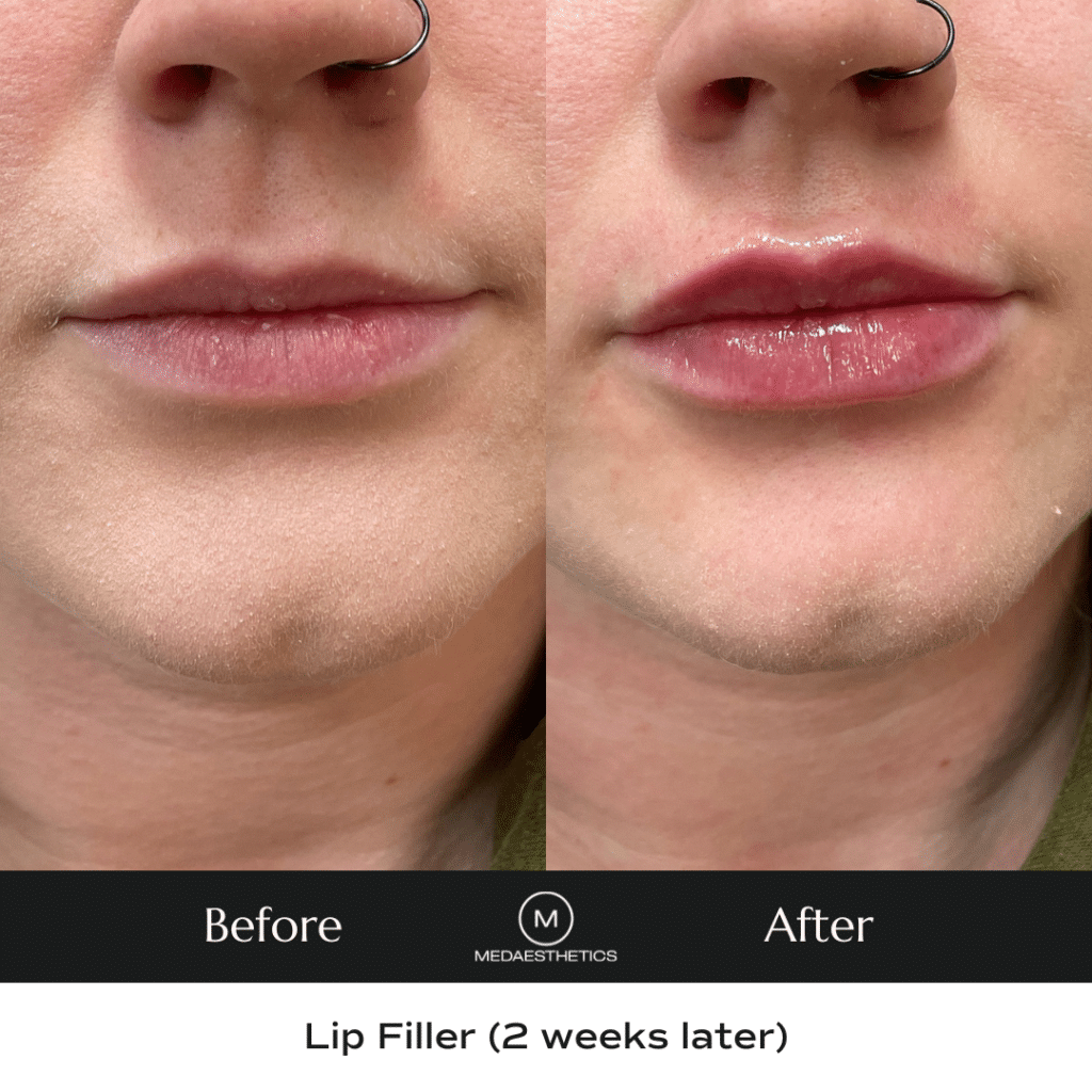A photo of two lips side by side before and after lip filler.