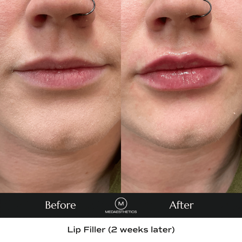 A photo of two lips side by side before and after lip filler. 