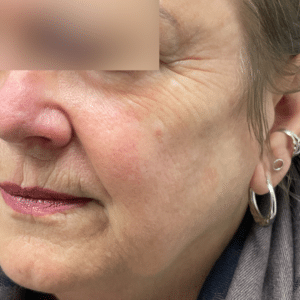BBL, Microneedling, Juvederm Filler