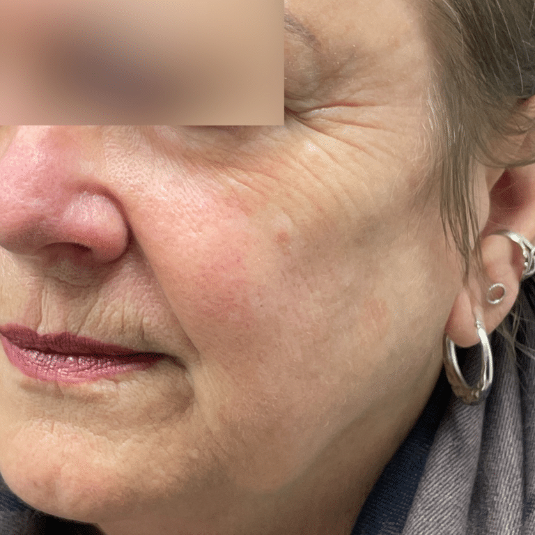 After Image: BBL, Microneedling, Juvederm Filler - left-side
