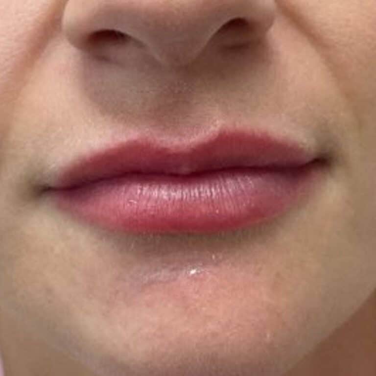 Before Image: Juvederm Lip Filler - front
