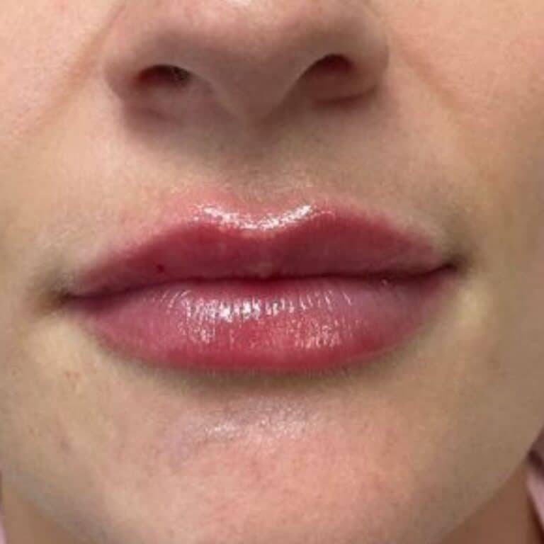 After Image: Juvederm Lip Filler - front