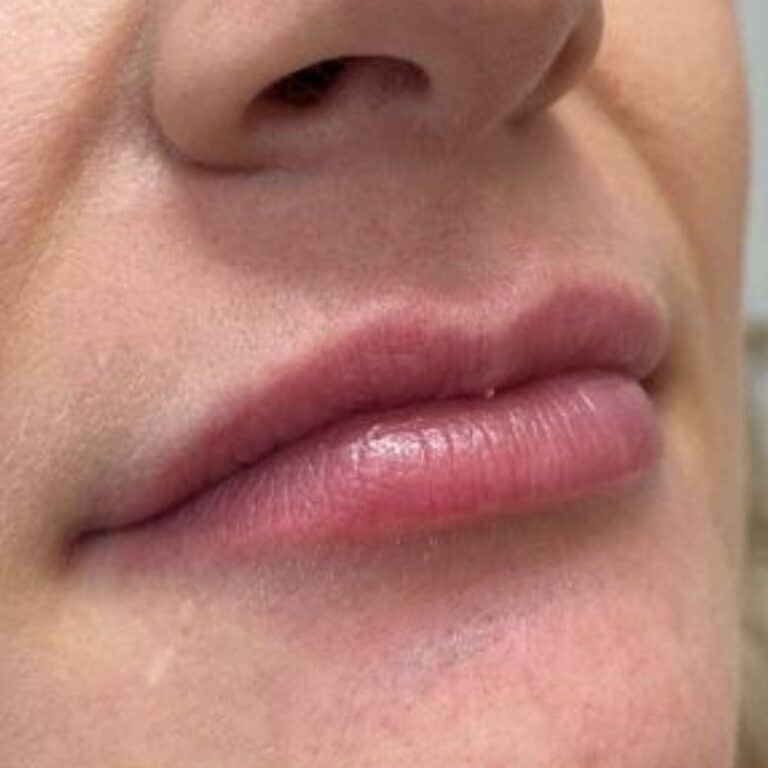 Before Image: Juvederm Lip Filler - right-side
