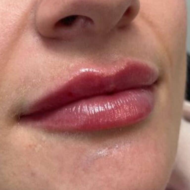 After Image: Juvederm Lip Filler - right-side