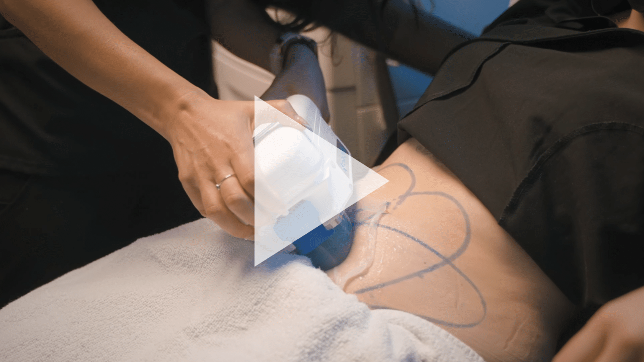 Advanced Aesthetics & Med Spa - Bye Bye Bra Rolls! Are you ready to smooth  out your back? CoolSculpting is a great option. . Give us a call at  410-420-4068 or visit