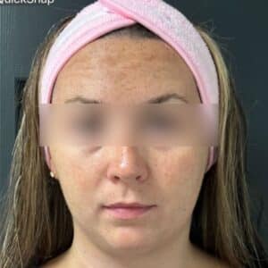 Before Image: Microneedling, BBL, and HydraFacials