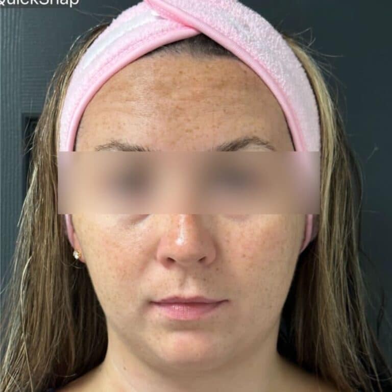 Before Image: Microneedling, BBL, and HydraFacials - front
