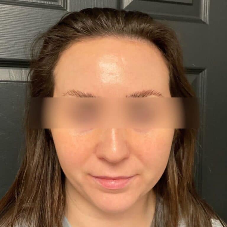 After Image: Microneedling, BBL, and HydraFacials - front