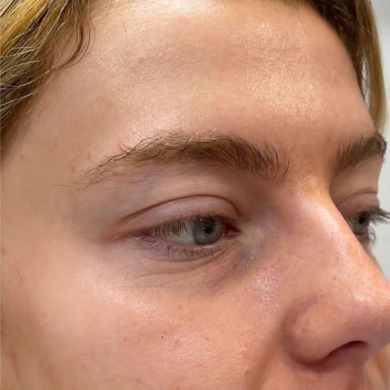 Before Image: Under Eye Filler - right-front-oblique