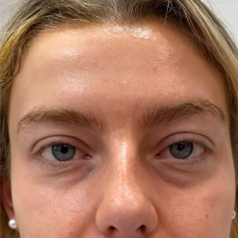 Before Image: Under Eye Filler - front