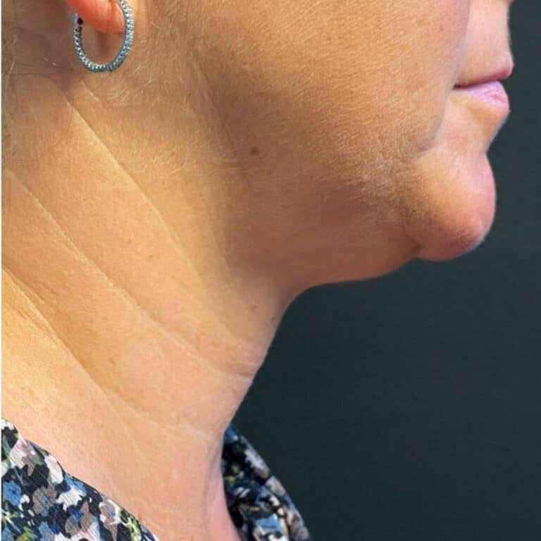 Before Image: Coolsculpting, Belkyra, and Filler - right-side
