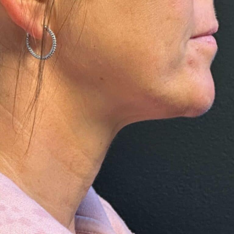 After Image: Coolsculpting, Belkyra, and Filler - right-side
