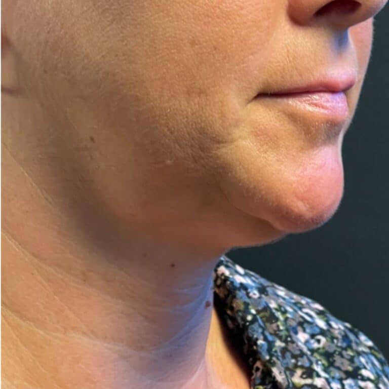 Before Image: Coolsculpting, Belkyra, and Filler - front