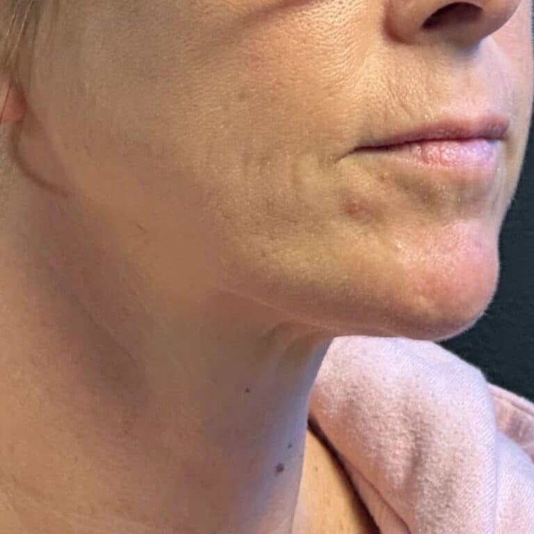 After Image: Coolsculpting, Belkyra, and Filler - front