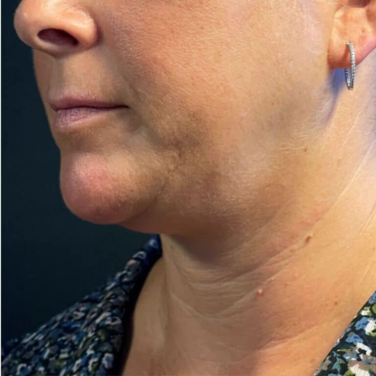 Before Image: Coolsculpting, Belkyra, and Filler - left-front-oblique