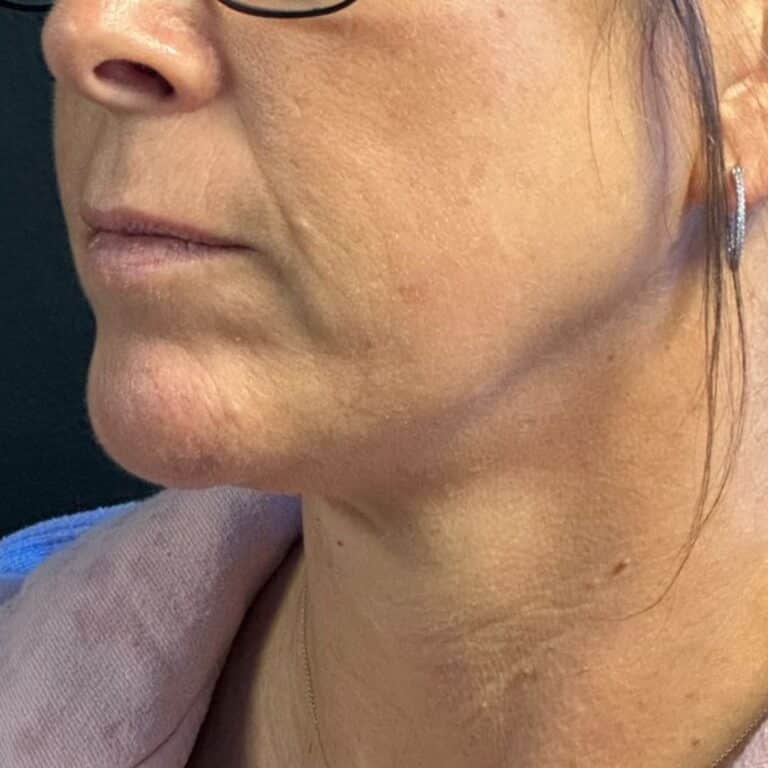 After Image: Coolsculpting, Belkyra, and Filler - left-front-oblique