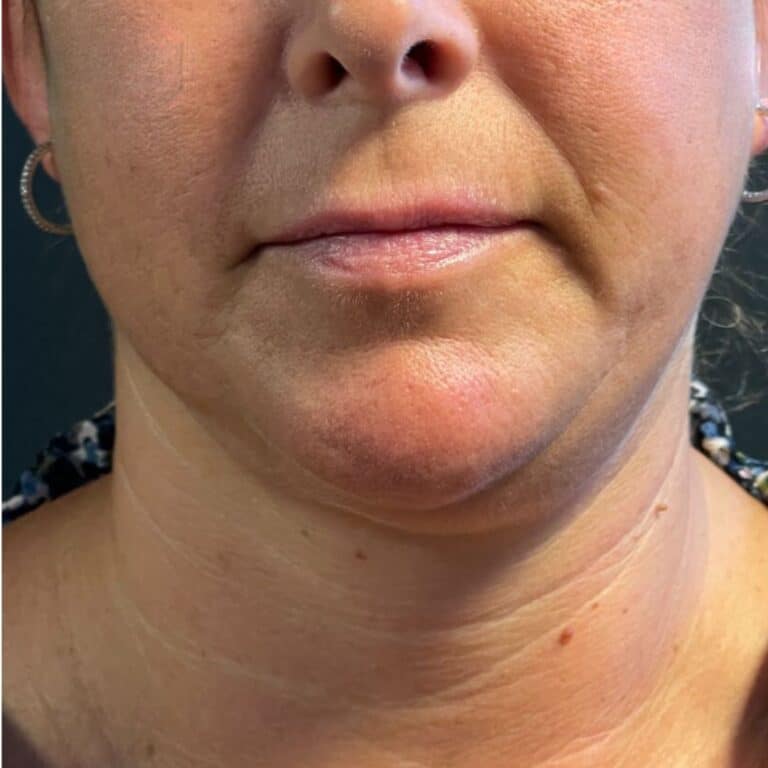 Before Image: Coolsculpting, Belkyra, and Filler - front