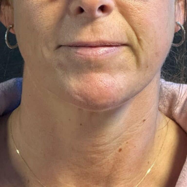 After Image: Coolsculpting, Belkyra, and Filler - front