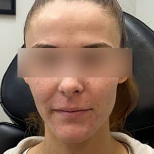 Before Image: Microneedling & Lip Filler