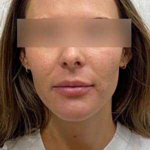 After Image: Microneedling & Lip Filler