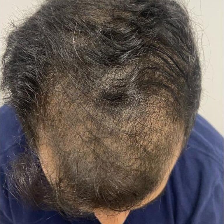 Before Image: PRP Hair Restoration - front