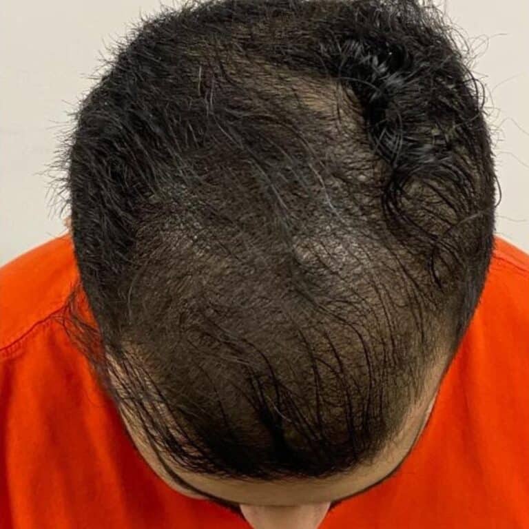 After Image: PRP Hair Restoration - front