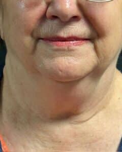 Before Image: CoolSculpting