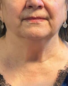 After Image: CoolSculpting