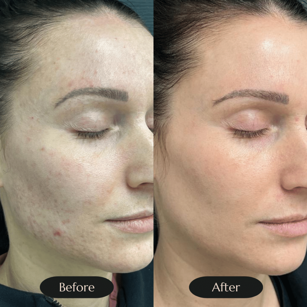 Developing Scars Acne Scars