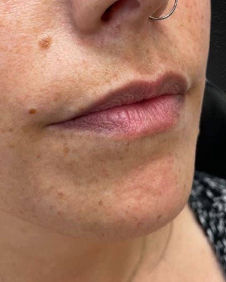 Before Image: Lip Filler -