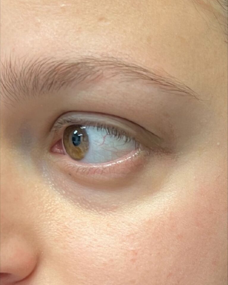 Before Image: Undereye Filler - front
