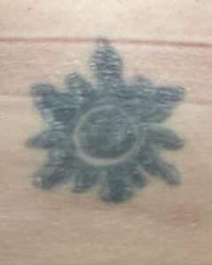 Before Image: Tattoo Removal