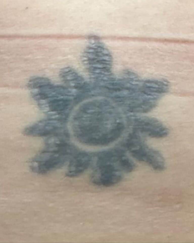 Before Image: Tattoo Removal - front