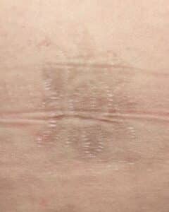 After Image: Tattoo Removal