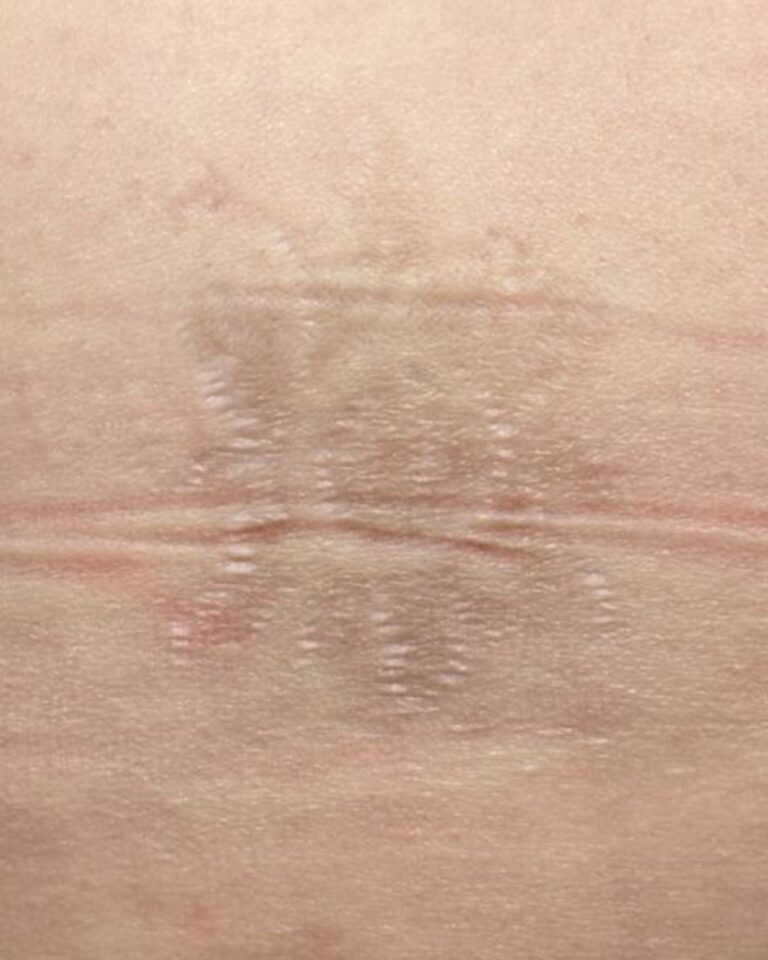 After Image: Tattoo Removal - front