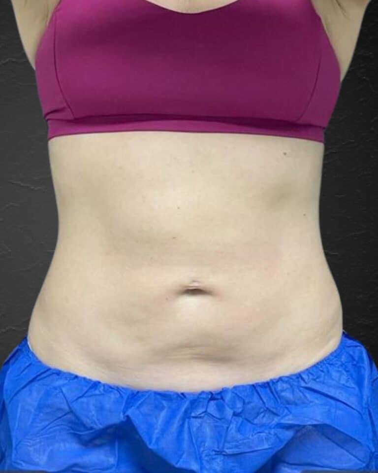 After Image: CoolSculpting - front