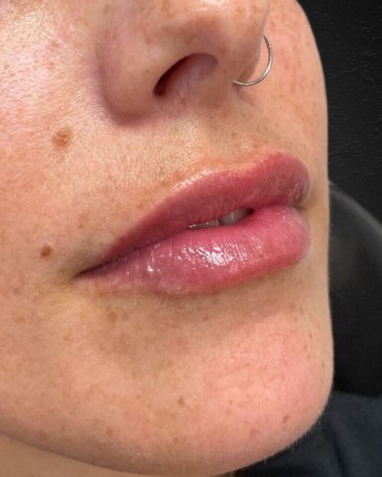 After Image: Lip Filler -