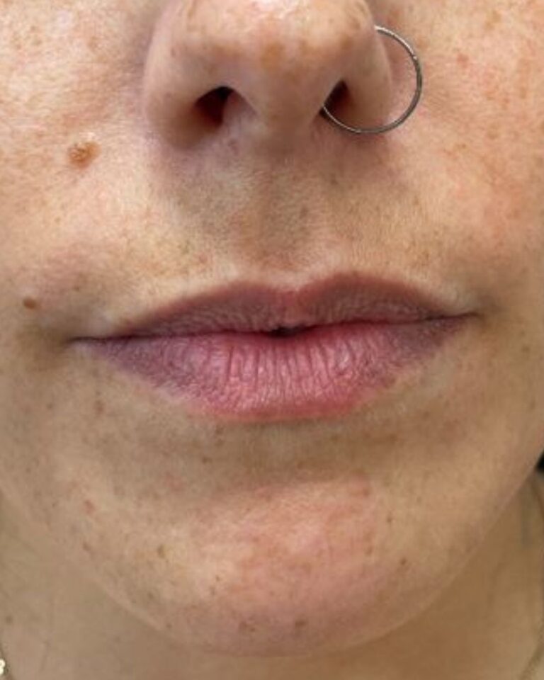 Before Image: Lip Filler - front