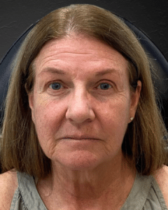 Before Image: BBL + Botox & Filler + HydraFacials + Skincare