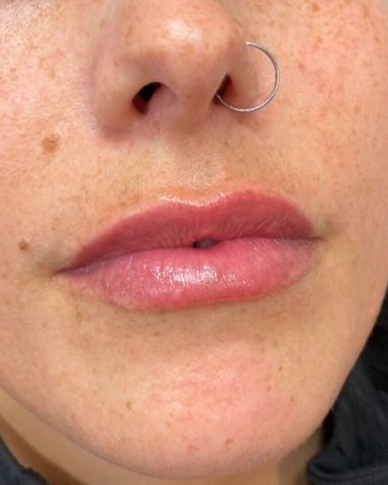 After Image: Lip Filler - front