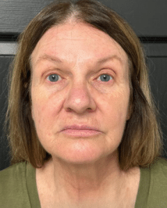 After Image: BBL + Botox & Filler + HydraFacials + Skincare