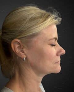 Before Image: MedAesthetics HydraLux Lift