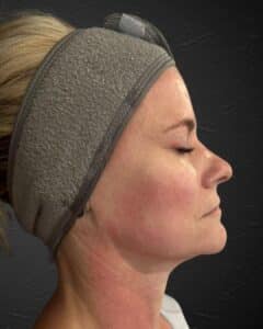 After Image: MedAesthetics HydraLux Lift